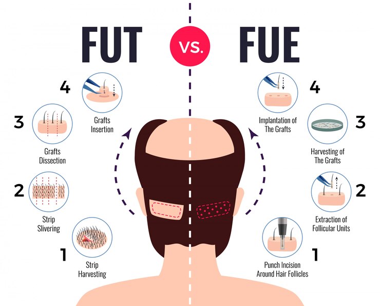 what is the difference between FUT vs FUE hair transplant procedure in Pakistan