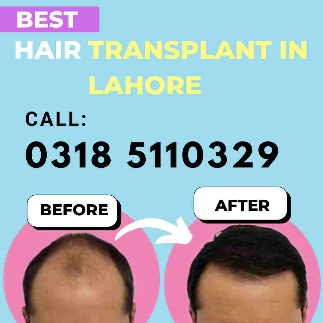 best hair transplant service in lahore